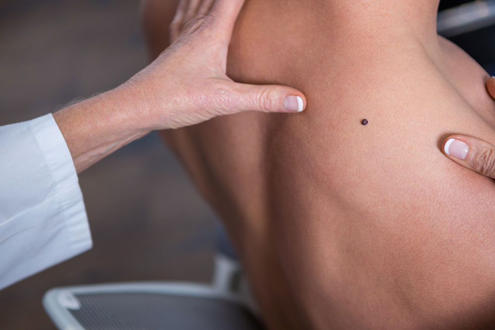 Common Signs and Symptoms of Melanoma to Note