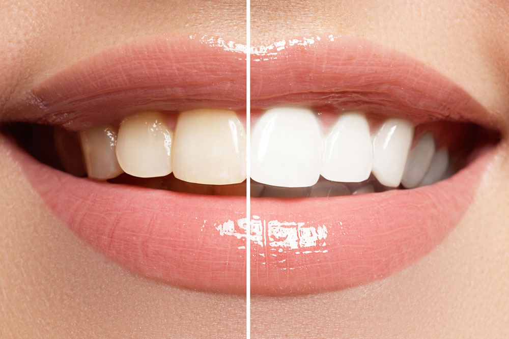 Six Natural Ways to Get Rid of Stained Teeth