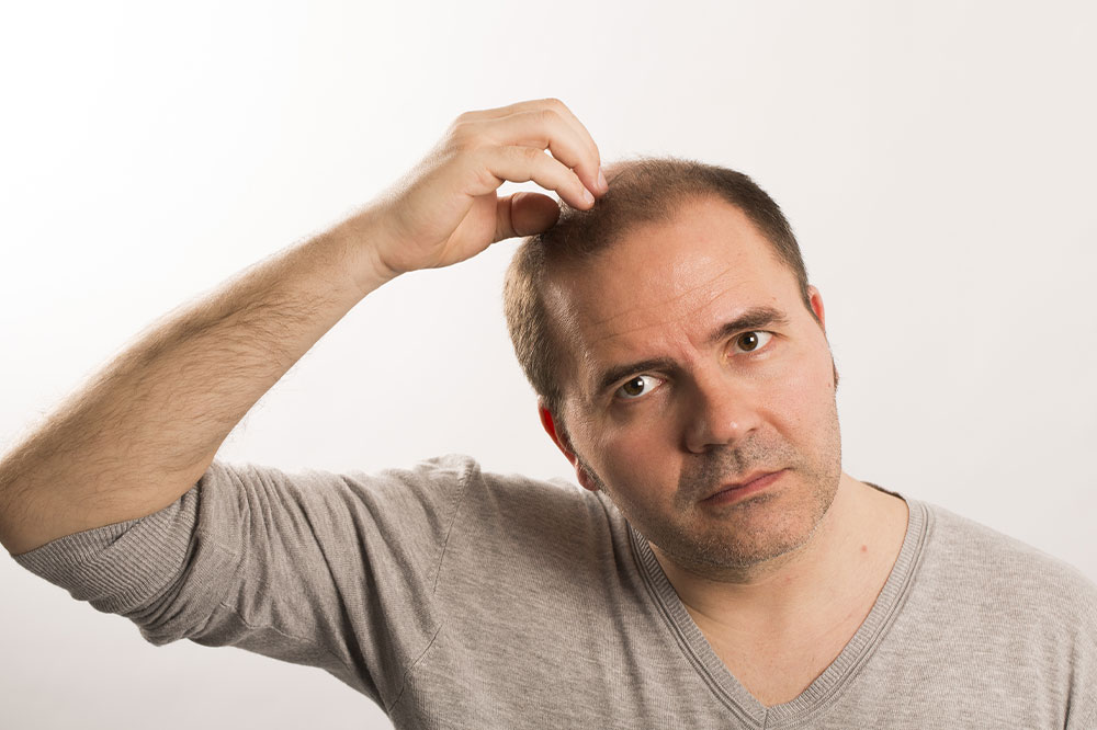 5 Natural Ways to Manage Male Pattern Baldness