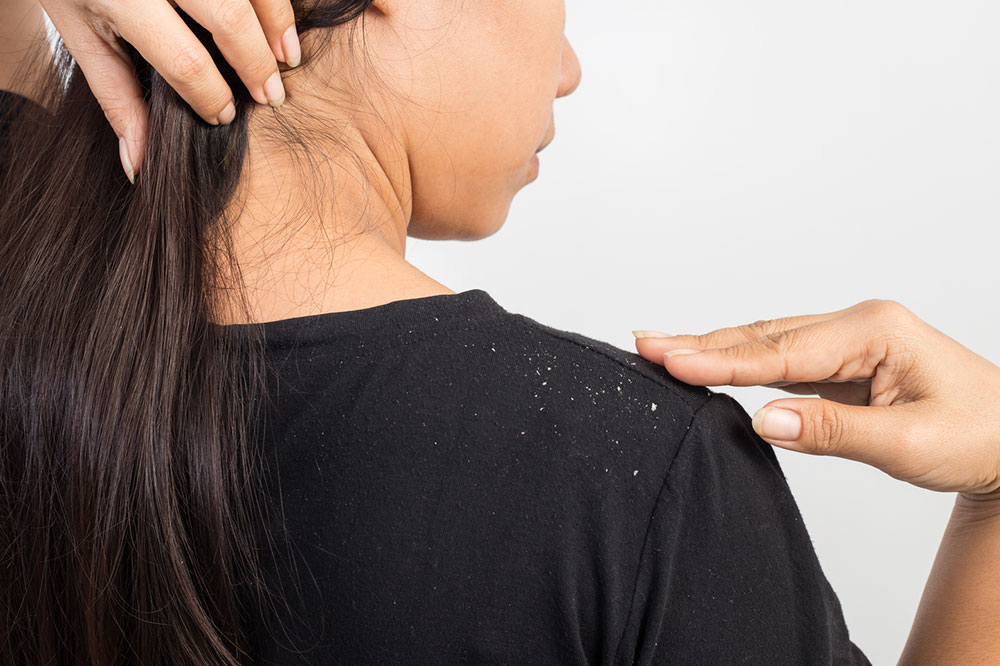 5 Useful Tips for Preventing Dandruff