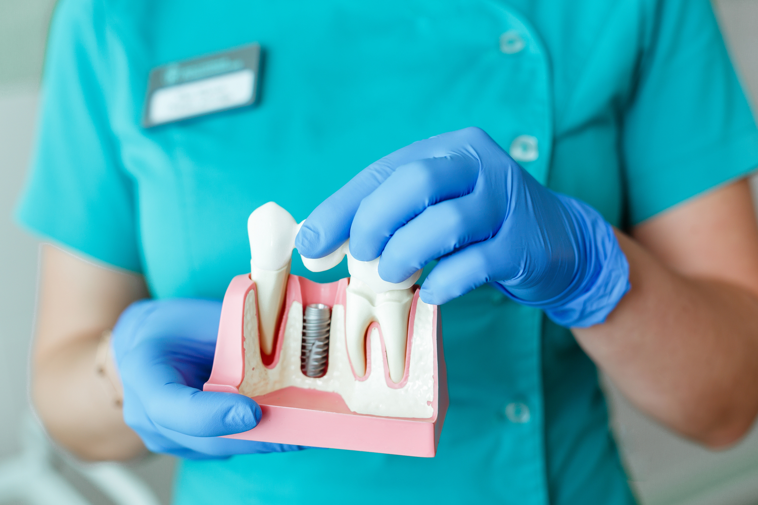 Dental Implant Cost: Instant Ways to Save on Dental Implants